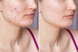 Comparison Image for skin-care - 1