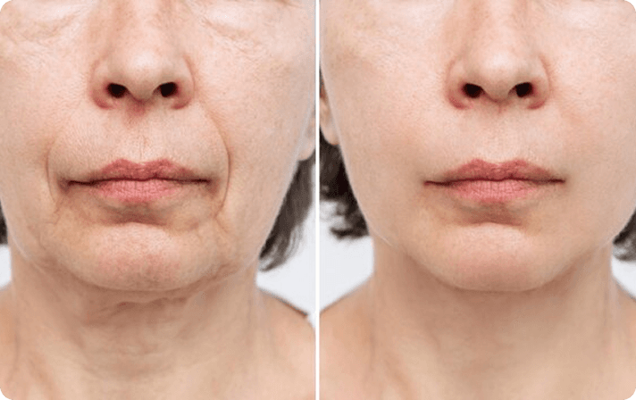 Comparison Image for injectables - 1