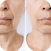 Comparison Image for injectables - 2